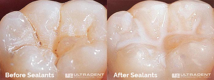 Fissure Sealants